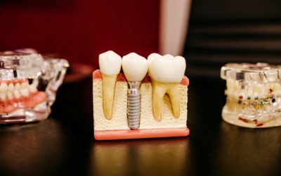 Kas sastāda zobu implantu cenu?