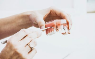 Viss, kas tev būtu jāzina par zobu implantiem