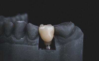 Kādi ir zobu implantu veidi?