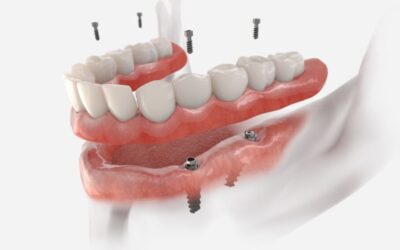 Kāds ir zobu implantu garantijas ilgums?