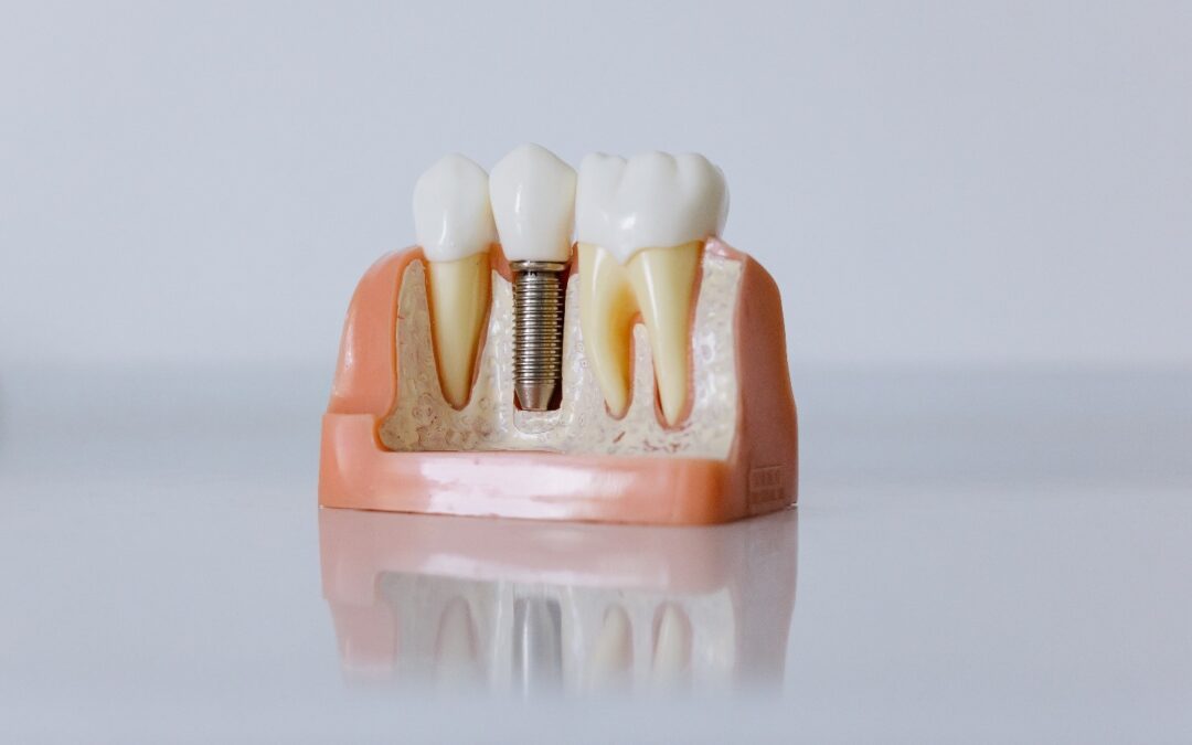 Cik bieži ir jāmaina zobu implanti?