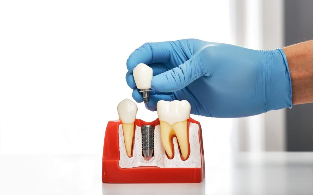 Kas notiek, ja iztrūkstošie zobi netiek aizstāti ar implantiem?