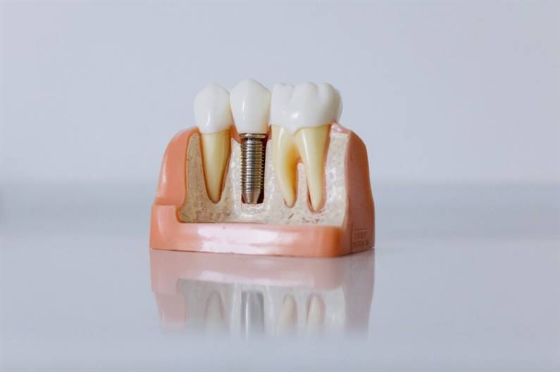 implanti zobu modelis griezuma