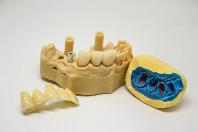 zobu implantu modelis