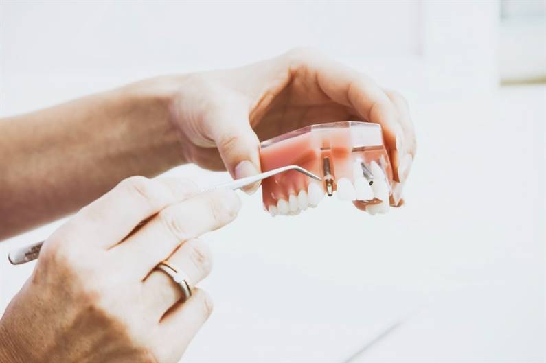 Viss, kas tev būtu jāzina par zobu implantiem