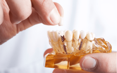 Zobu implanti – 4 pārsteidzoši fakti