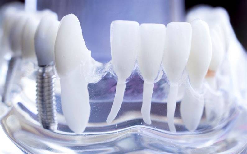 zobu implantu plastika modelis