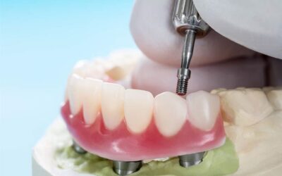 Zobu protēzes uz implantu pamata: Izmaksas, ieguvumi un uzturēšana