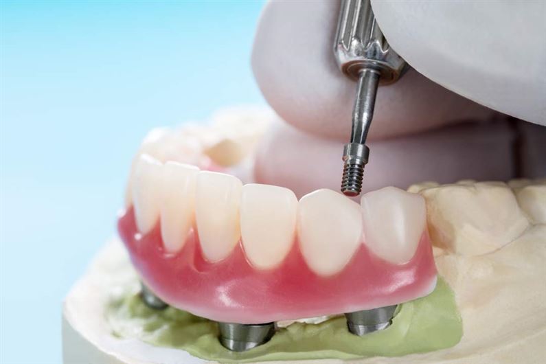 zobu protēzes un implanti