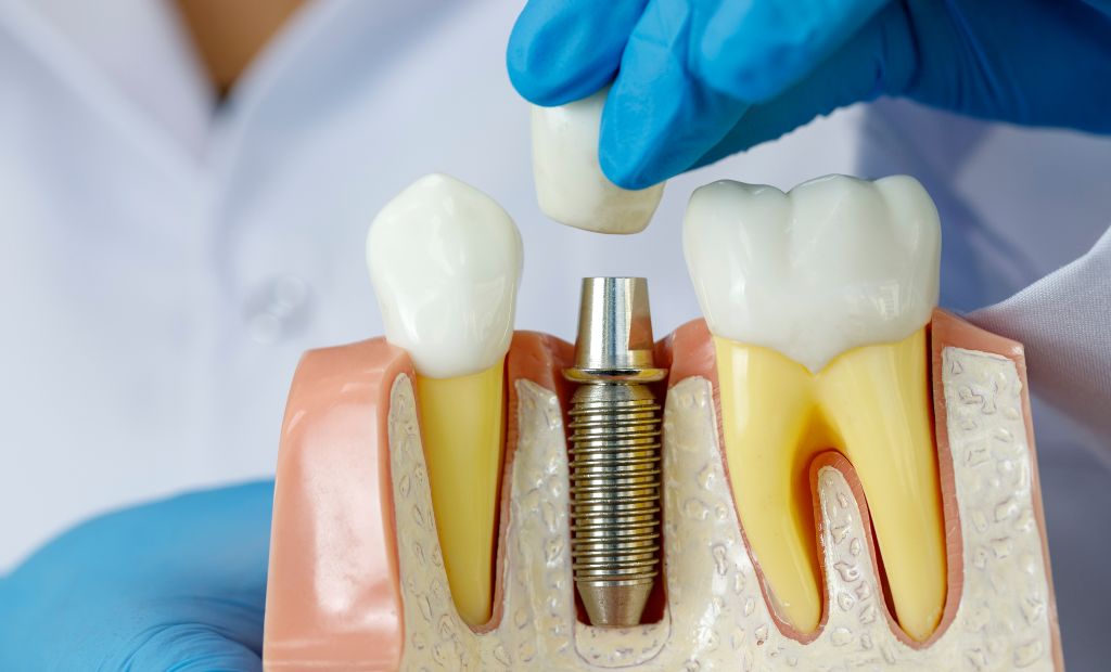Vai zobu implanti var izraisīt kādas veselības problēmas vai alerģiskas reakcijas?