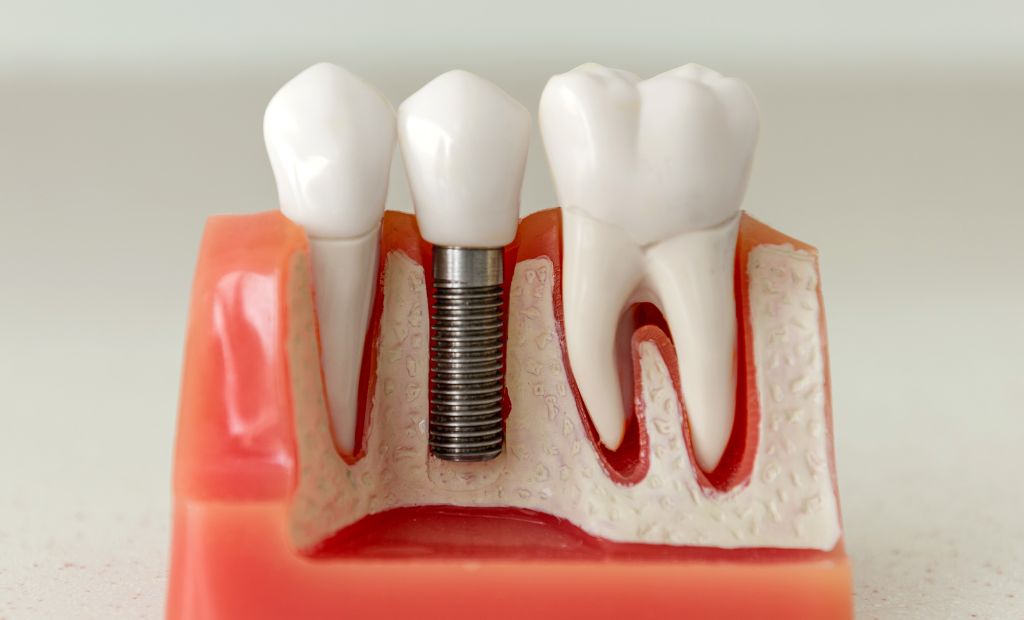 Kāpēc ir ļoti svarīgi pienācīgi rūpēties par zobu implantiem?