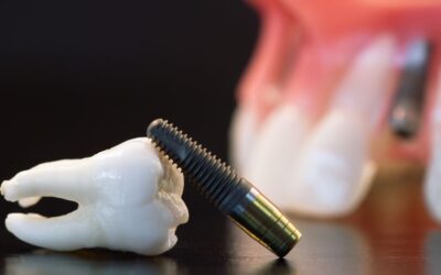 10 izplatītākie mīti par zobu implantiem