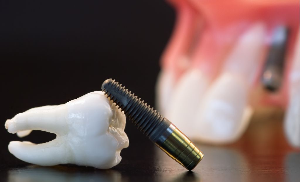 10 izplatītākie mīti par zobu implantiem