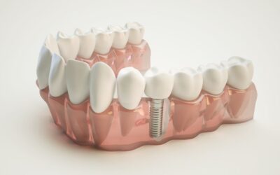 3D attēlveidošanas priekšrocības zobu implantu ķirurģijā