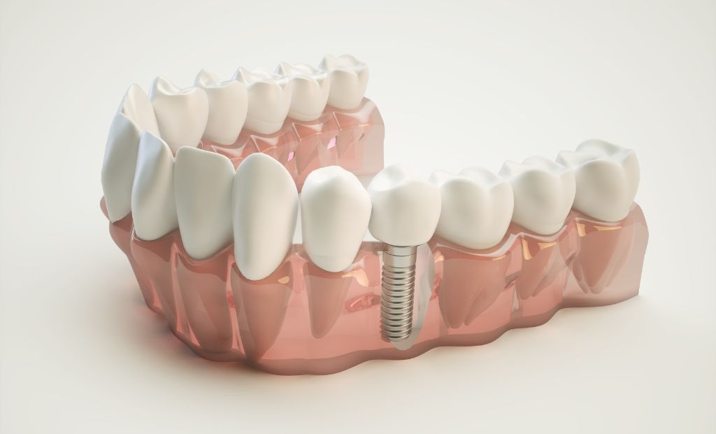 3D zobu implanti
