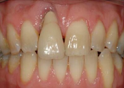 pirms zobu implantu ievietošanas