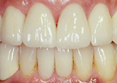 kvalitatīvi zobu implanti